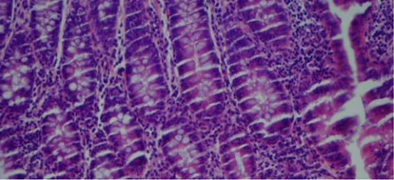 Figure 3 Micro-chatter seen in a section of colon.