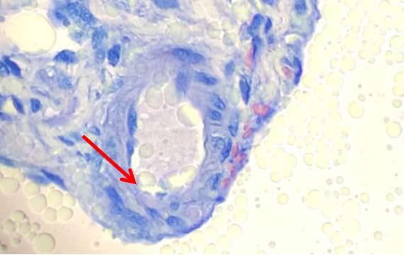 Figure 5 The water in this section has removed nearly all the cytoplasmic counterstain. Note the water droplets surrounding the section. Figure 5 The water in this section has removed nearly all the cytoplasmic counterstain. Note the water droplets surrounding the section.