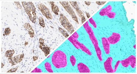 HALO-AI-Breast-IHC-Tumor-Tissue-Detection