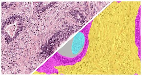 HALO-AI-Gastric-H&E-Tumor-Tissue-Detection