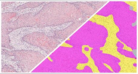 HALO-AI-HNSCC-H&E-Tumor-Tissue-Detection
