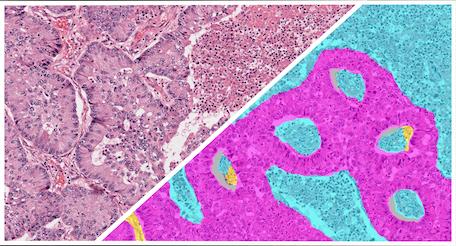 HALO-AI-NSCLC-H&E-Tumor-Tissue-Detection