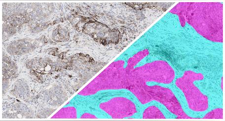 HALO-AI-NSCLC-IHC-Tumor-Tissue-Detection