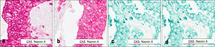 Figure 2 Cytokeratin 5 and Napsin A