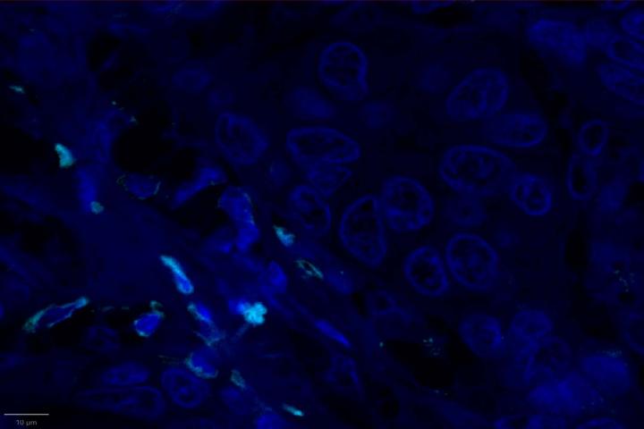CXCR3 Experimental Multiomic Staining in Breast Cancer