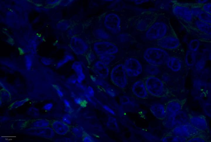 IFNG Experimental Multiomic Staining in Breast Cancer