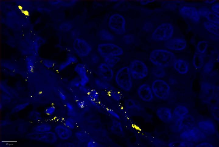CXCL9 Experimental Multiomic Staining in Breast Cancer