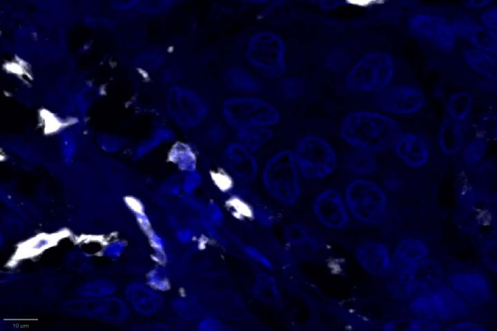 CD3 - Experimental Multiomic Staining in Breast Cancer