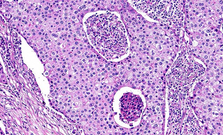 Colon-Cancer-Tissue-T2-0074B1-Breast-20x-0221-2-750x454