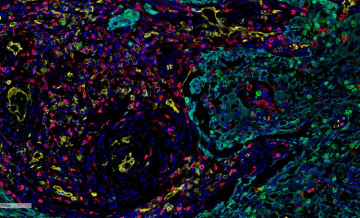 Colorectal-Cancer-Tissue-5-COLOR-_2-better-and-prefer-750x410