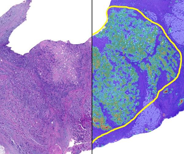 H&E digital slide (left) with CRC Macrodissection AI markup (right) displaying the tumor cell density heatmap.
