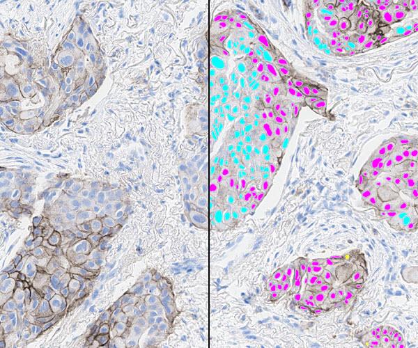 featured-image-lung-pd-l1_Split_600x500