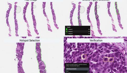 Breast core biopsy example using hotspot 1