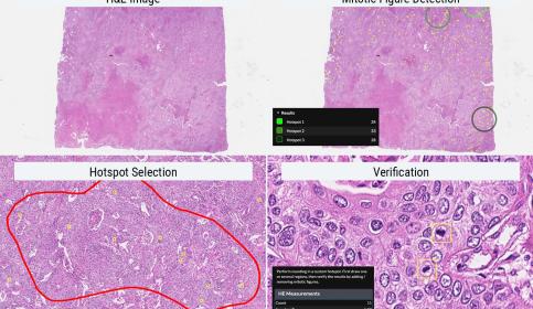 Lung-cancer-example-using-custom-hotspot