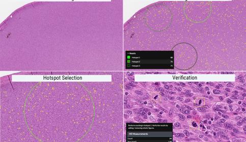 Soft tissue sarcoma example using hotspot 1